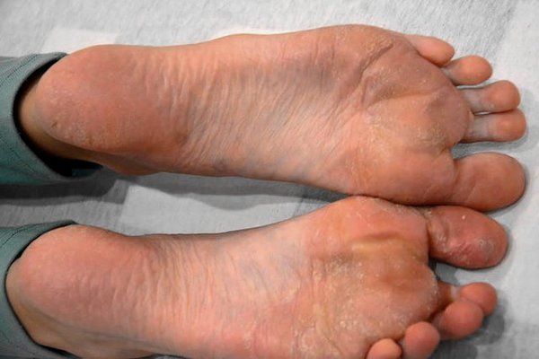 nohy psoriáza - 2 týdny po terapii